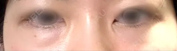 下まぶたの脂肪取り APOLLO BEAUTY CLINIC BEFORE メイン用