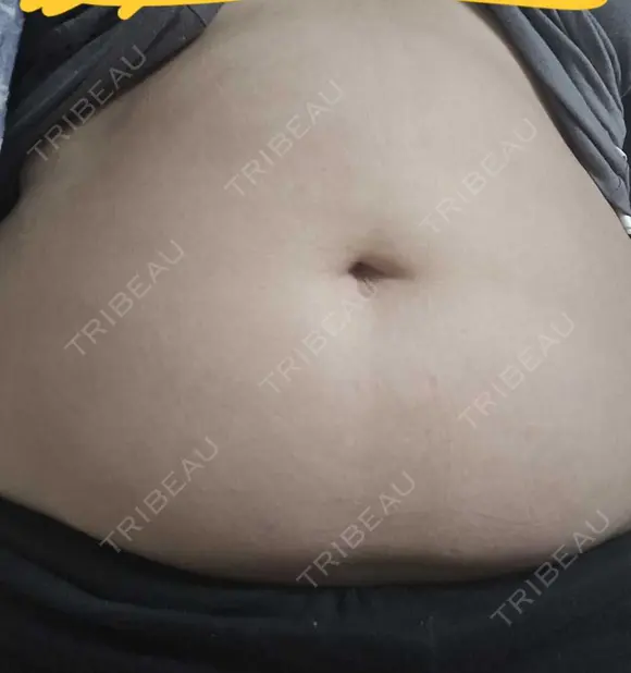 脂肪冷却（二の腕） / 脂肪冷却（お尻） DMTC CLINIC 渋谷院 BEFORE メイン用