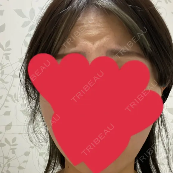 ボトックス（あご） / ボトックス（エラ・小顔） / ボトックス（肩） / ボトックス（眉間） / ボトックス（目尻） / ボトックス（人中） メディカルアルファクリニック BEFORE メイン用