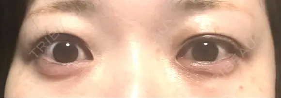 目尻切開 / タレ目形成・グラマラスライン（埋没） / ピコスポット LOUIS CLINIC 二子玉川院【ルイクリニック】 BEFORE メイン用