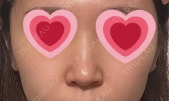 鼻尖形成（切開） / 小鼻縮小（切開） / 軟骨移植 / 鼻修正 / 鼻柱下降・鼻唇角形成（猫手術） R Beauty CLINIC 大阪院 BEFORE メイン用