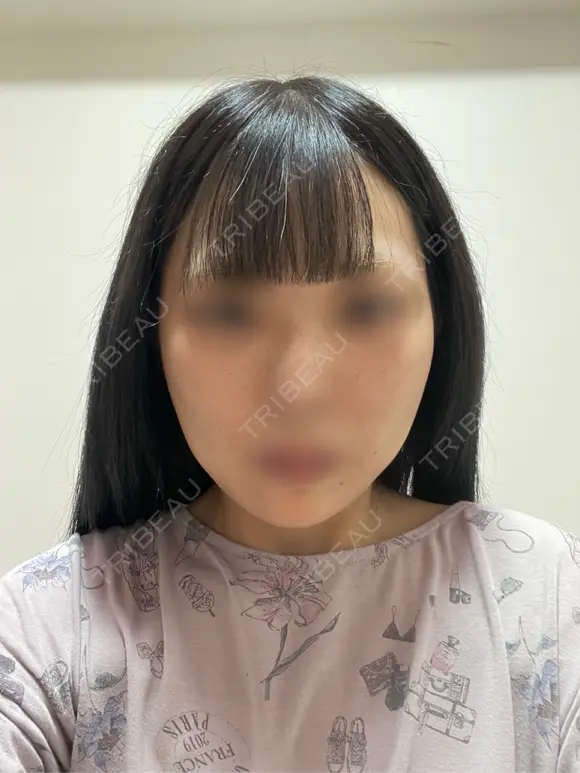 ボトックス（あご） M'sクリニック【エムズクリニック】 BEFORE メイン用