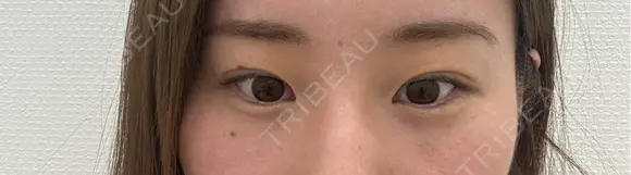 二重埋没 東京シンデレラ美容外科 池袋院 BEFORE メイン用