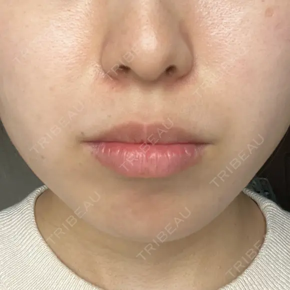 ヒアルロン酸注入（あご） / ヒアルロン酸注入（唇） / ボトックス（口角） フィラークリニック 大阪梅田院 BEFORE メイン用