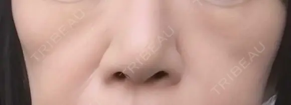 ヒアルロン酸注入（頬） 目白ホワイトクリニック BEFORE メイン用