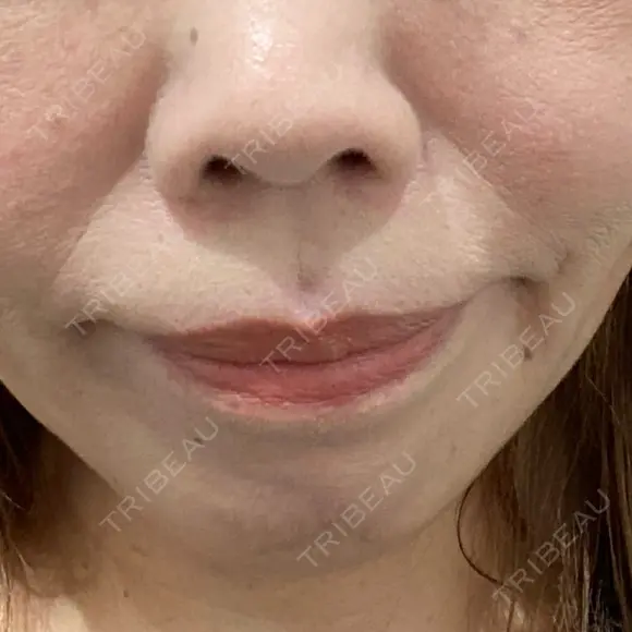 ボトックス（あご） / 肌ヒアルロン酸注入（たるみ・シワ改善） / 高濃度ビタミンC点滴 カジュアルクリニック 平塚院 BEFORE メイン用