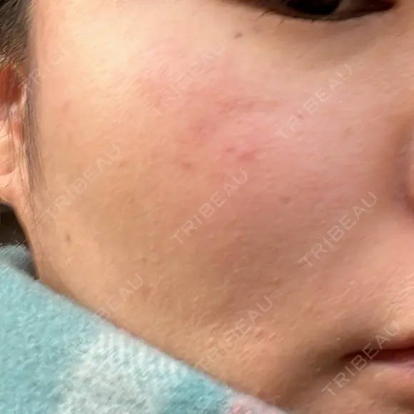 光治療（フォトフェイシャルなど） 81clinic BEFORE メイン用