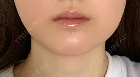 ボトックス（エラ・小顔） / ヒアルロン酸注入（唇） / ボトックス（口角） / ボトックス（人中） L‘amour clinic Tokyo【ラムールクリニック東京】 BEFORE メイン用