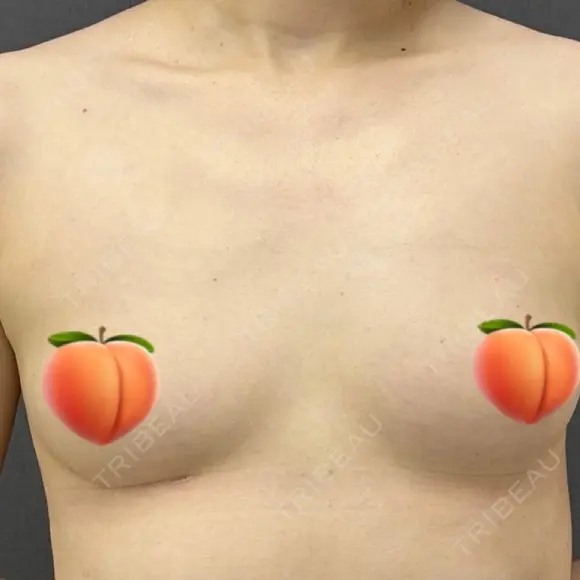 豊胸（シリコンバッグ） / シワ取りボトックス ルーチェクリニック 銀座院 BEFORE メイン用