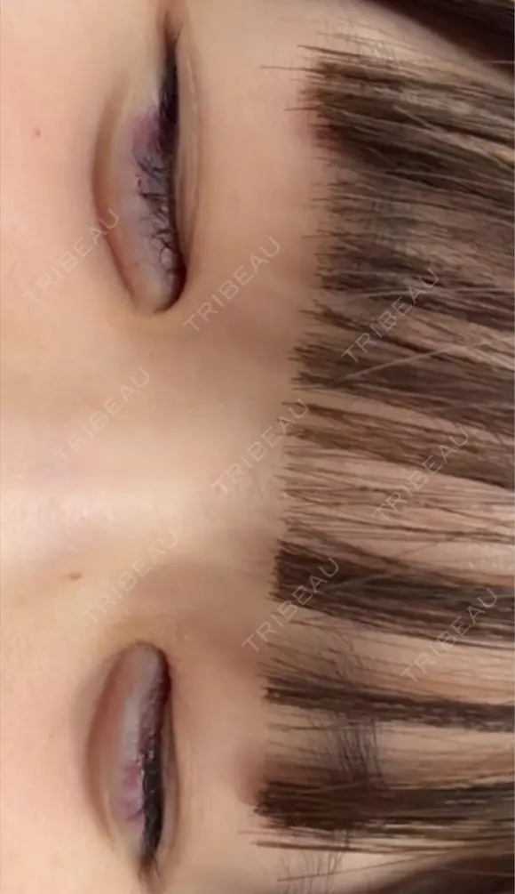 ヒアルロン酸注入（涙袋） 共立美容外科 梅田院 BEFORE メイン用