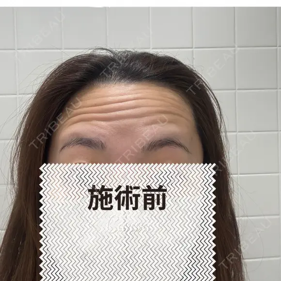 ボトックス（額） アネシス美容クリニック BEFORE メイン用