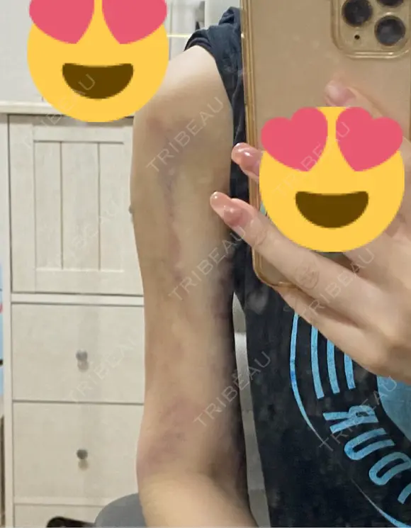 脂肪吸引（二の腕） Lipo Clinic omotesando BEFORE メイン用