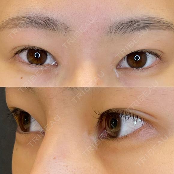 タレ目形成・グラマラスライン（埋没） LOUIS CLINIC 二子玉川院【ルイクリニック】 BEFORE メイン用