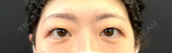 二重埋没 湘南美容クリニック 千葉センシティ院 BEFORE メイン用