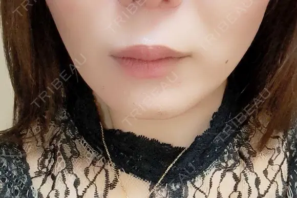 ボトックス（エラ・小顔） BiBiクリニック BEFORE メイン用