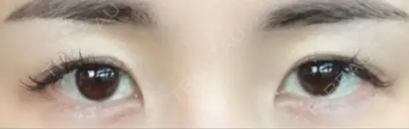 目頭切開 / 上まぶたたるみ取り / 眉下切開 Lovelyan整形外科 BEFORE メイン用