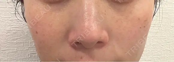 ピコスポット 博多もへじのクリニック BEFORE メイン用