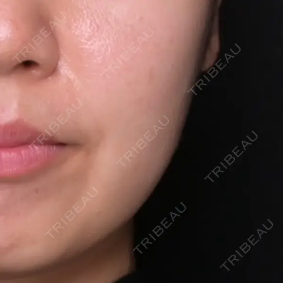ボトックス（あご） / ボトックス（エラ・小顔） Zetith Beauty Clinic 福岡院 BEFORE メイン用