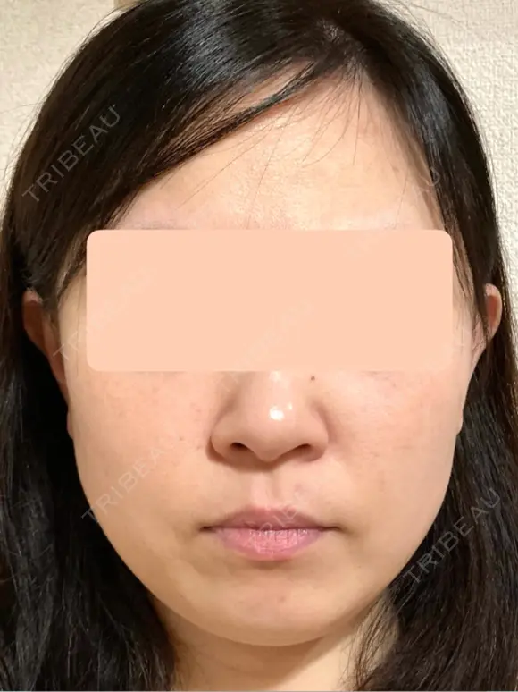 糸リフト / 脂肪吸引（顔） 脂肪吸引ラボトウキョウ BEFORE メイン用