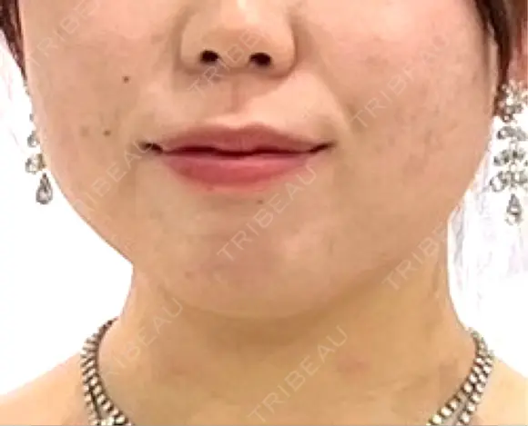 ボトックス（エラ・小顔） BiBiクリニック BEFORE メイン用