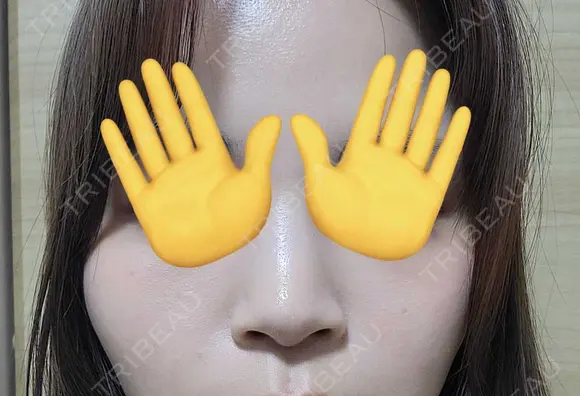 小鼻縮小（切開） / その他（鼻） EMMO FACE CLINIC 東京三田院 BEFORE メイン用