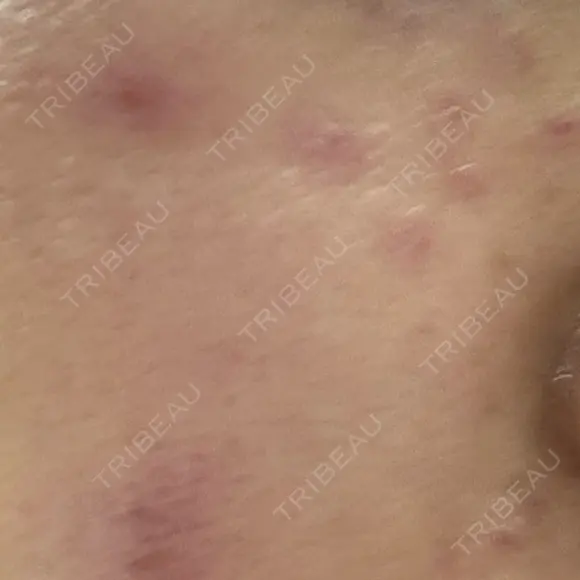 ピコスポット 東京シルククリニック 新宿院 BEFORE メイン用