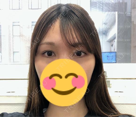 ヒアルロン酸注入（涙袋） 共立美容外科 京都院 BEFORE メイン用