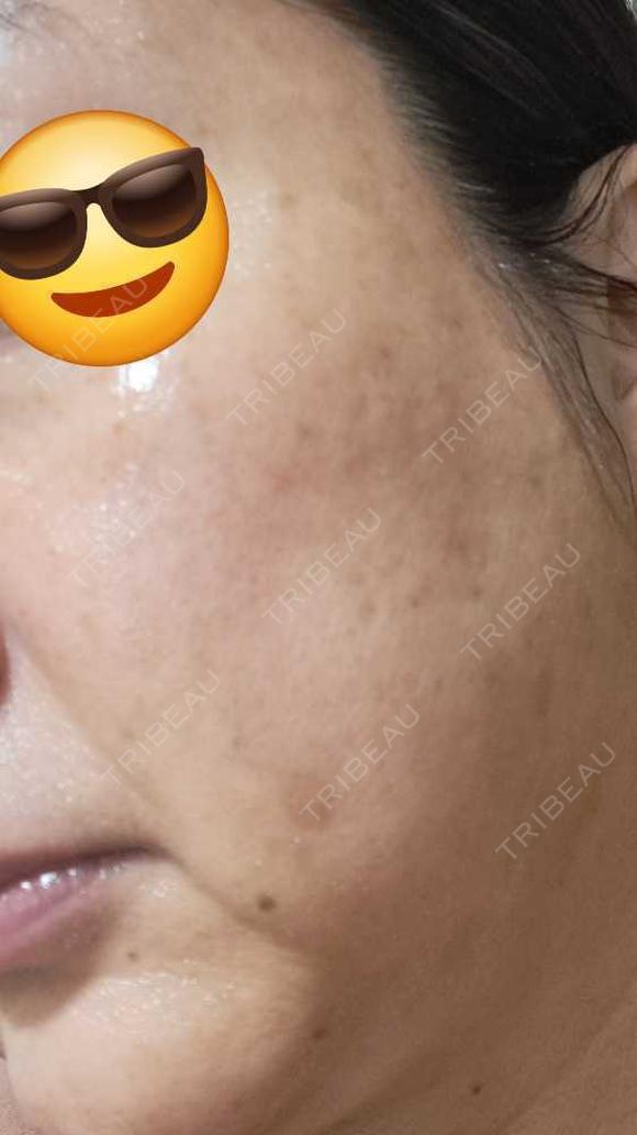 水光注射（ハリ・美肌） しんゆり美容健康クリニック BEFORE メイン用