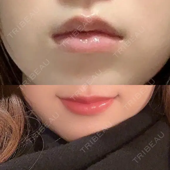 ヒアルロン酸注入（涙袋） / ヒアルロン酸注入（唇） ブルームクリニック（BLOOM CLINIC） BEFORE メイン用