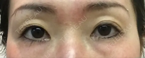 二重埋没 千里中央ゆみスキンクリニック BEFORE メイン用