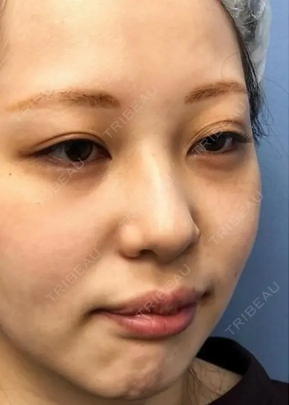 二重埋没 / 目頭切開 / 鼻尖形成（切開） / 鼻中隔延長（切開） / 軟骨移植 / ヒアルロン酸注入（鼻） / ヒアルロン酸注入（あご） 湘南美容クリニック 新潟院 BEFORE メイン用