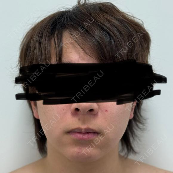 糸リフト / 脂肪吸引（顔） / 脂肪吸引注射（顔） / ヒアルロン酸注入（あご） SEA CLINIC（シークリニック） BEFORE メイン用