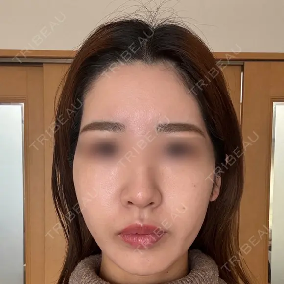 額を丸く / こめかみ形成 / 脂肪注入（額） 湘南美容クリニック 吉祥寺院 BEFORE メイン用