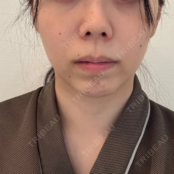鼻尖形成（切開） / 小鼻縮小（切開） / 軟骨移植 RIVER CLINIC（リバークリニック） BEFORE メイン用