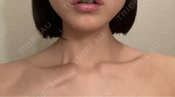 ボトックス（肩） ルラ美容クリニック 名古屋本院 BEFORE メイン用