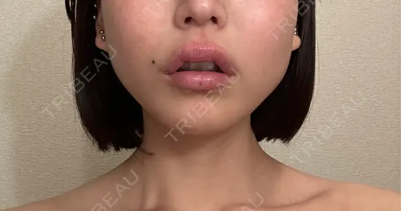 ボトックス（エラ・小顔） ルラ美容クリニック 名古屋本院 BEFORE メイン用