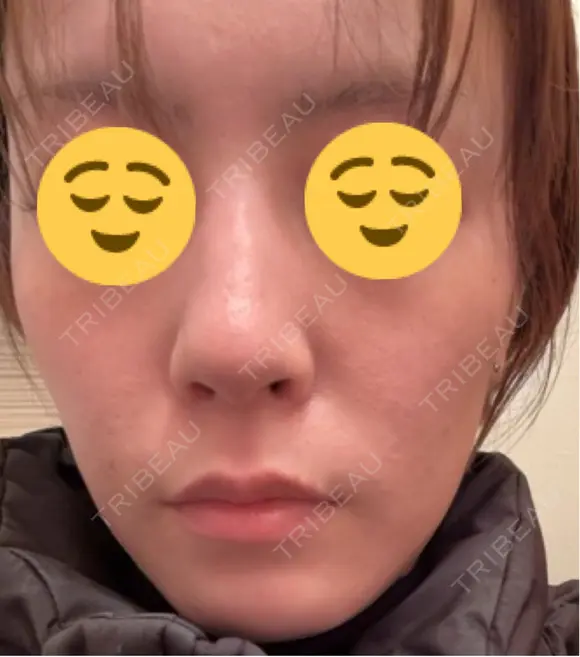 光治療（フォトフェイシャルなど） メディカルアルファクリニック BEFORE メイン用