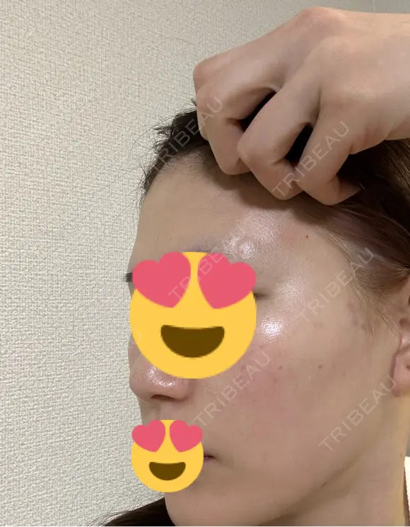 額を丸く / 脂肪注入（肌） / 脂肪注入（額） 湘南美容クリニック 柏院 BEFORE メイン用