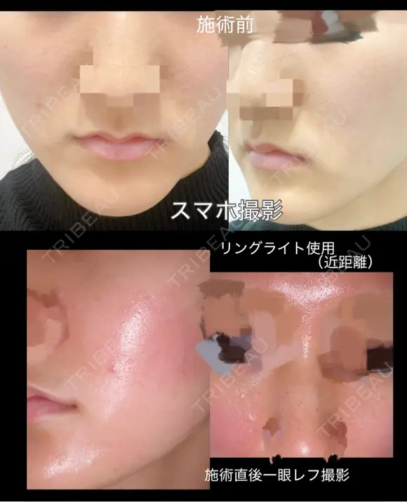 ヴァンパイアフェイシャル 東京美容クリニック 表参道本院 BEFORE メイン用