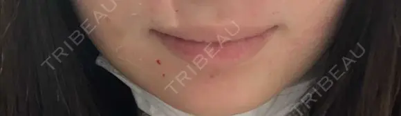 ボトックス（口角） / シワ取りボトックス / ボトックス（人中） LE CLINIC BEFORE メイン用