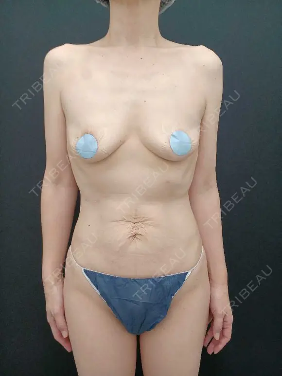 豊胸（脂肪注入） 湘南美容クリニック 吉祥寺院 BEFORE メイン用