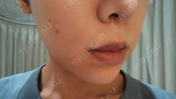 ニキビ治療 The Beauty Clinic SENDAI BEFORE メイン用