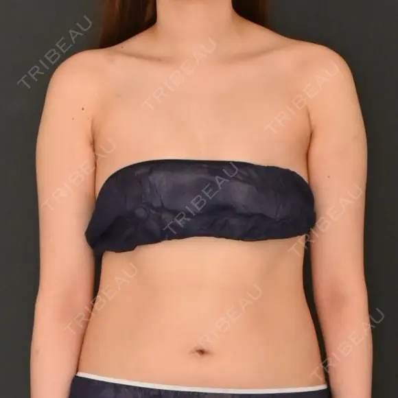 脂肪吸引（二の腕） / 脂肪吸引（背中） Lipo Clinic omotesando BEFORE メイン用