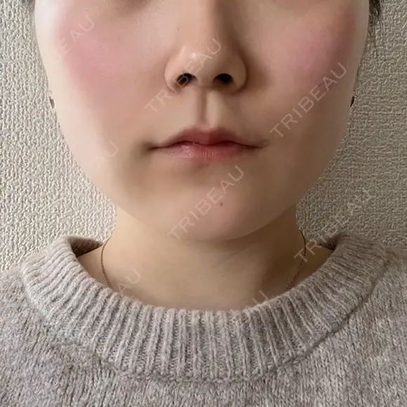 その他（鼻） / ボトックス（あご） / ボトックス（口角） / ボトックス（眉間） / ボトックス（人中） TCB東京中央美容外科 岡山院 BEFORE メイン用