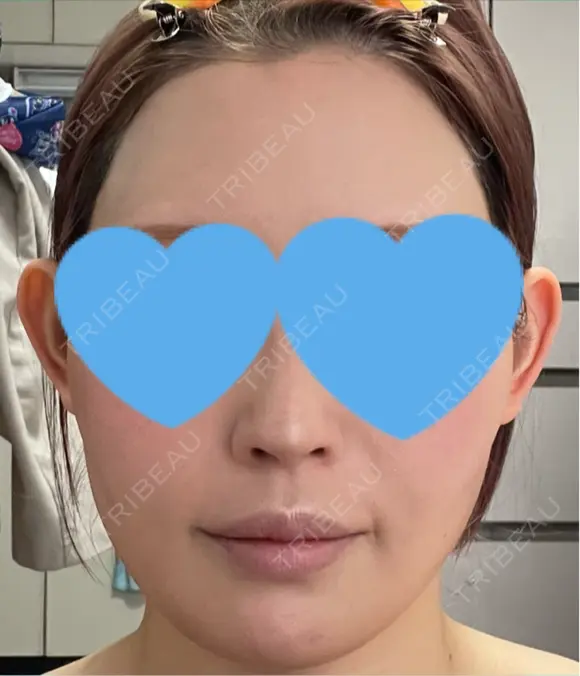 ハイフ（顔） / RF（高周波）たるみ治療 Chloe Cheongdam Clinic （クロエチョンダムクリニック） BEFORE メイン用