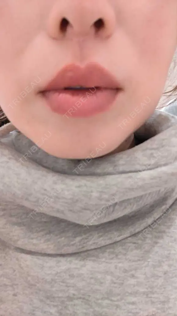 肌ヒアルロン酸注入（たるみ・シワ改善） HAAB×DREAM BEAUTY CLINIC 大阪梅田院 BEFORE メイン用