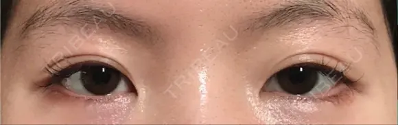 二重埋没 / 目頭切開 / 眼瞼下垂（切開） / 目尻切開 グロービー美容整形外科 BEFORE メイン用