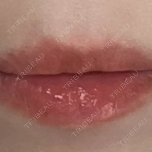 ヒアルロン酸注入（唇） / ヒアルロン酸注入（目の下） KIMI CLINIC 形成・美容外科 BEFORE メイン用