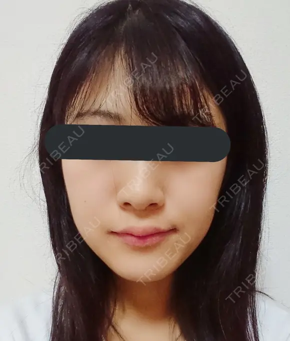 隆鼻術 / 小鼻縮小（切開） 湘南美容クリニック 熊本院 BEFORE メイン用