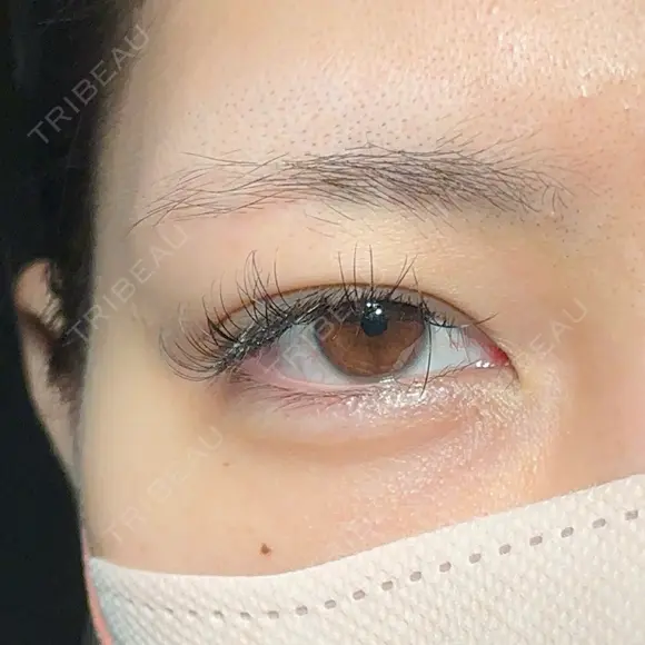 二重埋没 / 目頭切開 アリエル美容クリニック 大宮院 BEFORE メイン用